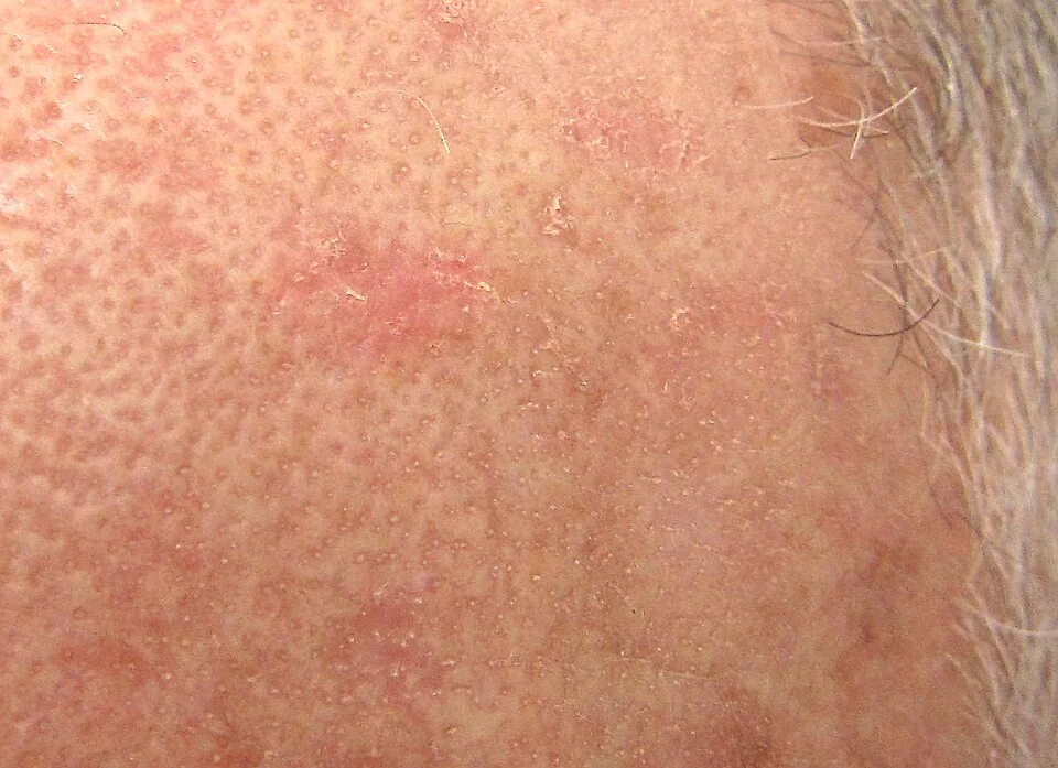 Close-up photograph of chronically sun-damaged skin showing several rough, scaly, erythematous actinic keratoses with a sandpaper-like texture.