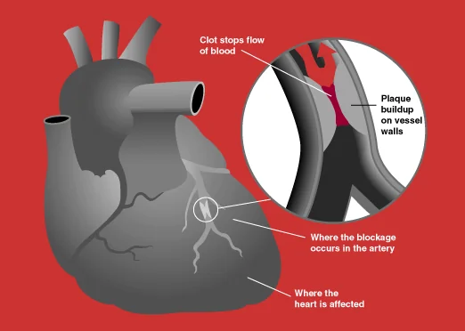 Diagram of the heart with a coronary artery blocked by a thrombus, and the wedge of myocardium supplied by that vessel shaded to show the area of infarction downstream of the occlusion.
