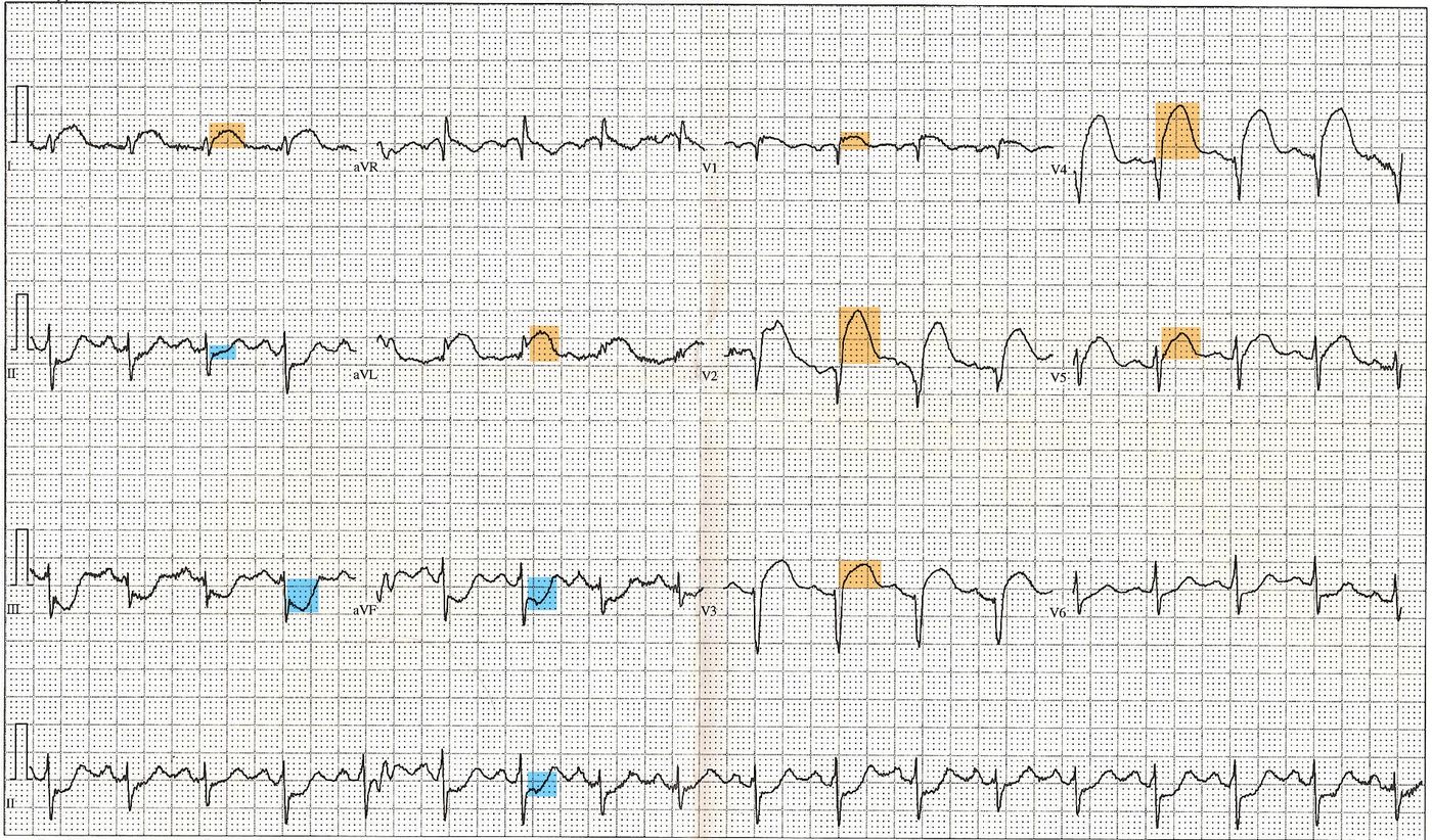 A 12-lead ECG showing ST elevation in the anterior chest leads, with the elevated ST segments highlighted, in a patient with an acute anterior myocardial infarction.