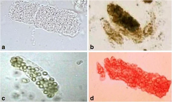 Composite light microscopy image of urine sediment panels showing renal tubular epithelial cell casts, a dark granular muddy brown cast, a white blood cell cast and a red blood cell cast.