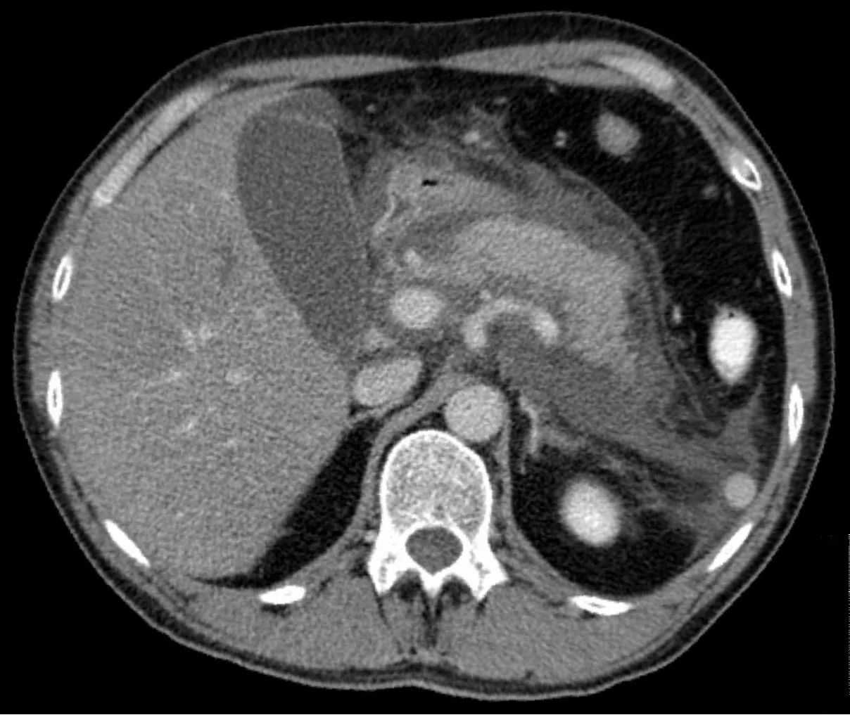 Axial contrast CT of the abdomen showing a swollen, oedematous pancreas with surrounding inflammatory fat stranding and peripancreatic fluid.