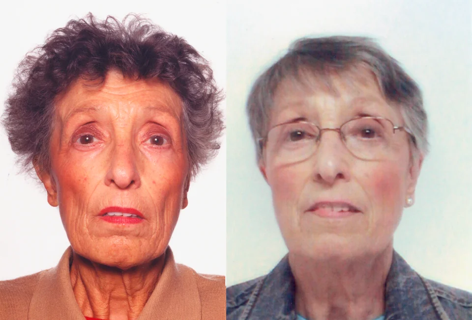 Two frontal photographs of the same older woman side by side; on the left her face and neck are diffusely deeply tanned and darkened, and on the right after treatment her skin is of normal pale complexion.