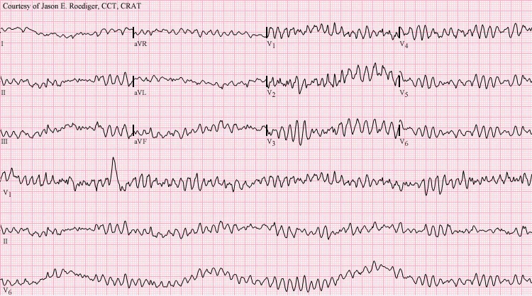 12-lead ECG showing ventricular fibrillation: every lead shows a chaotic, irregular waveform of varying amplitude with no identifiable QRS complexes, P waves or organised electrical activity.