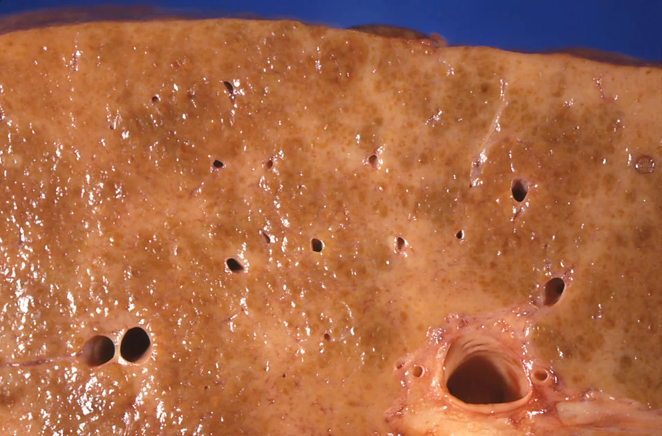 Gross pathology specimen of a liver with alcohol-related cirrhosis, showing a nodular surface with diffuse fibrous scarring.
