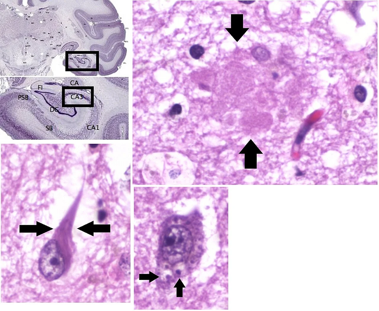 Composite histopathology panel of the hippocampus showing an extracellular amyloid plaque, intracellular neurofibrillary tangles, and granulovacuolar degeneration, with a low-power image indicating the CA3 location.