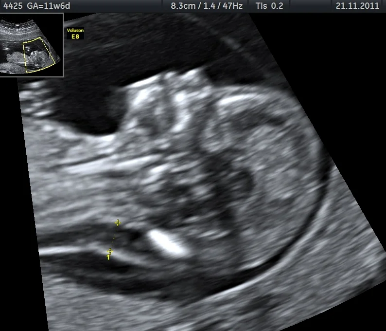 A first-trimester ultrasound image of a fetus in mid-sagittal section at 11 weeks and 6 days gestation, with calliper marks measuring a fluid collection at the back of the fetal neck.