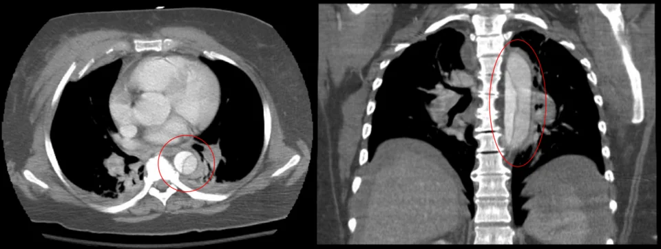 Axial and coronal contrast-enhanced CT images of the chest showing the descending thoracic aorta divided by a thin intimal flap into two contrast-filled channels, a true and a false lumen.