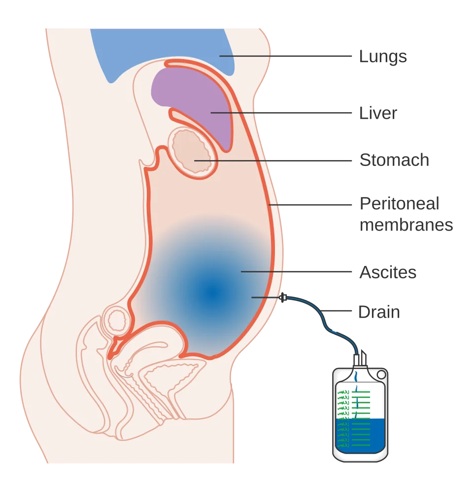Diagram showing a drain inserted through the abdominal wall into the peritoneal cavity to remove ascitic fluid.