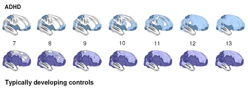 Two rows of brain images showing the age at which each cortical area reaches peak thickness, with the ADHD sequence above lagging behind the typically developing sequence below.