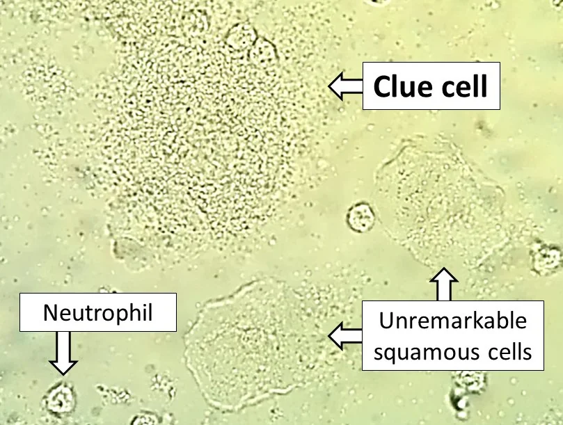 Light microscopy of a vaginal wet mount showing a clue cell with a stippled, bacteria-coated border at bottom left, alongside unremarkable squamous epithelial cells.