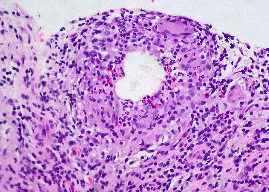 Close-up photograph of a chalazion of the upper eyelid, showing a discrete rounded swelling within the lid away from the lash margin, with normal overlying skin and no surrounding redness.