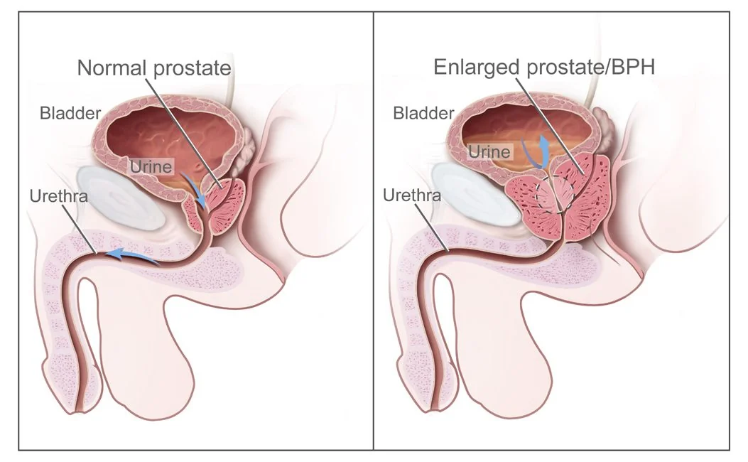 Two-panel medical illustration comparing normal male urinary anatomy with benign prostatic hyperplasia, showing on the right an enlarged prostate compressing the urethra and pressing on the bladder above it.