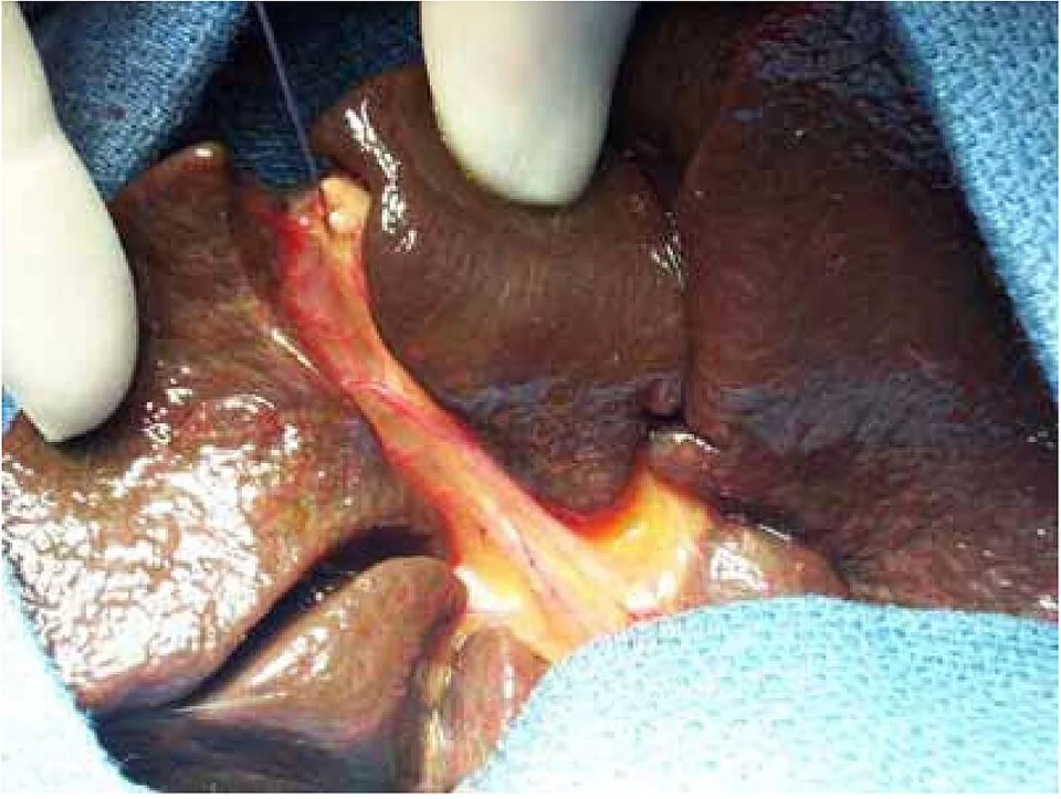 Operative photograph of an infant's liver hilum showing a fibrous, obliterated biliary remnant instead of a patent bile duct system.
