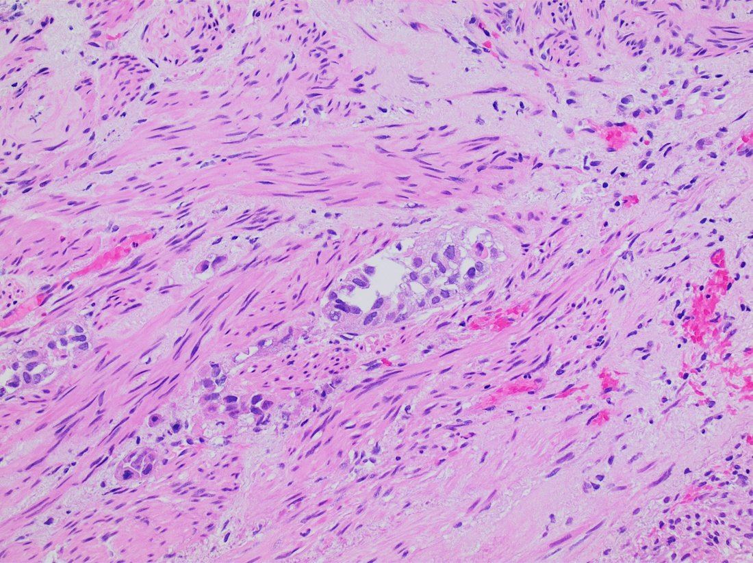 Light micrograph of bladder tissue stained with haematoxylin and eosin showing nests of malignant urothelial cells extending between and infiltrating bundles of smooth muscle.