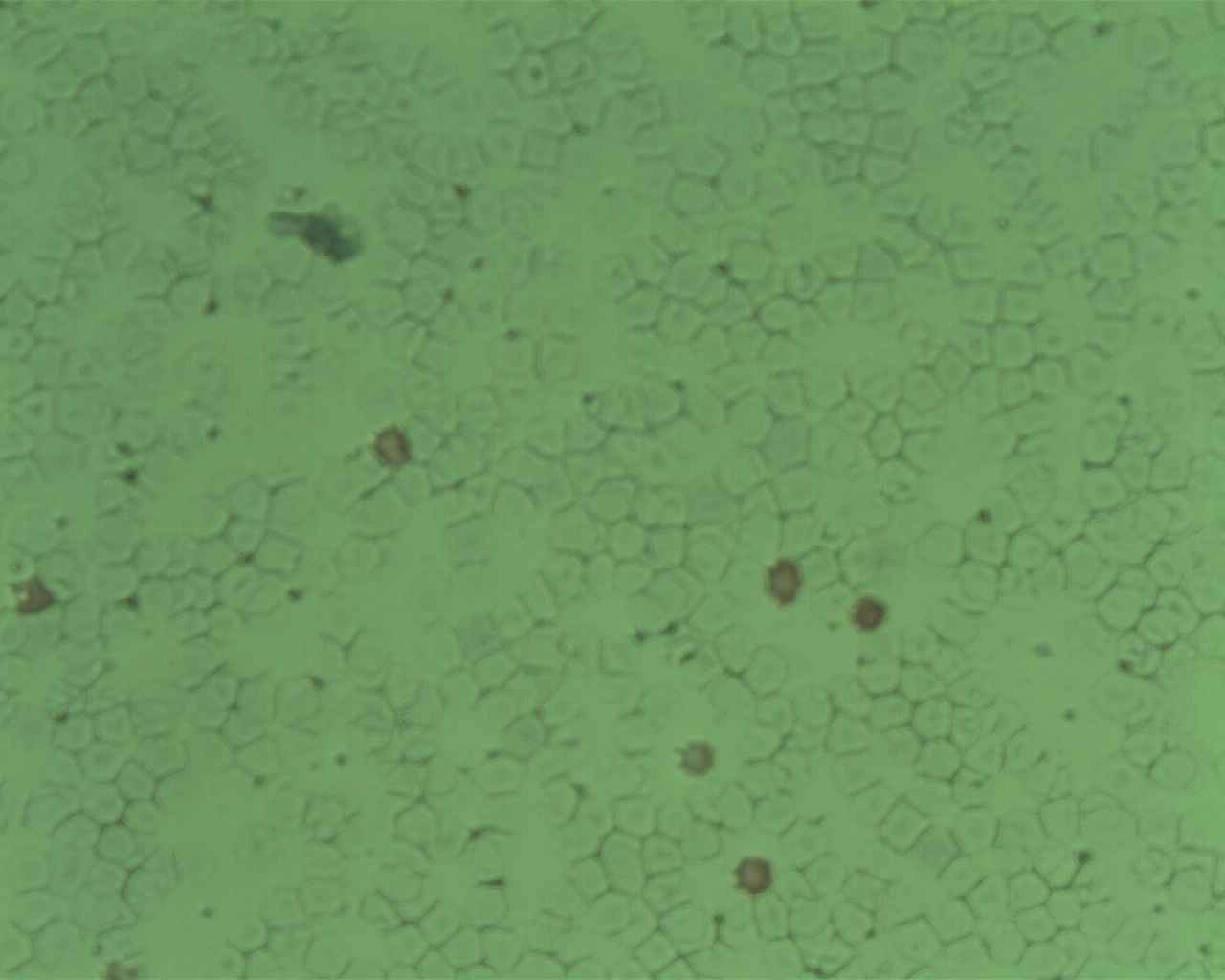 Blood film from a Kleihauer test showing darkly stained pink fetal red cells among pale maternal ghost cells.