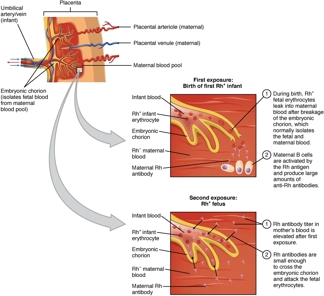 Diagram showing rhesus sensitisation at the birth of a first RhD positive infant and the effect of maternal antibody on a subsequent RhD positive fetus.