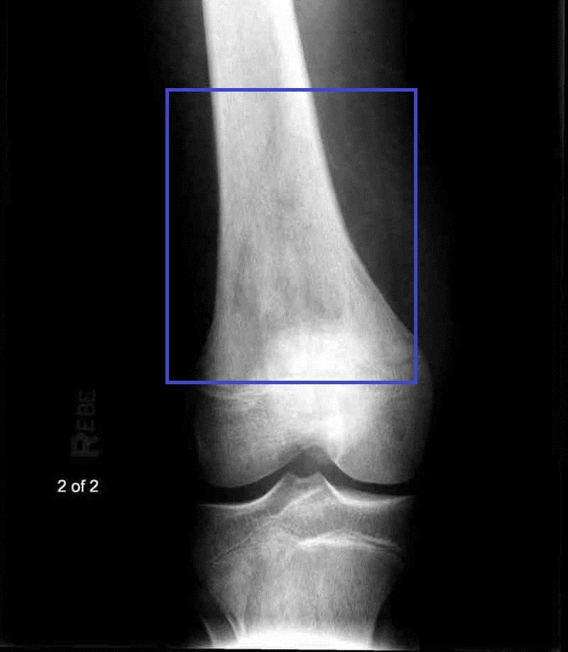 Radiograph of the knee showing an aggressive, destructive lesion in the metaphysis of the distal femur, with a mixed lytic and sclerotic pattern, cortical destruction and periosteal new bone radiating outwards from the shaft.