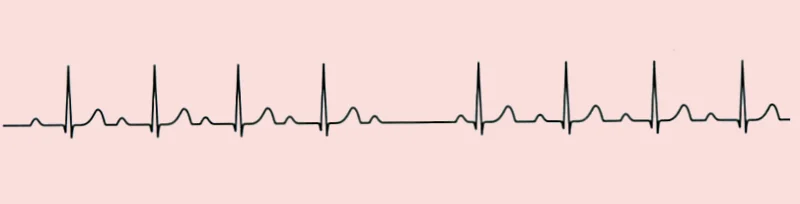 An ECG rhythm strip in which the PR interval lengthens progressively over several consecutive beats until one P wave is not followed by a QRS complex, leaving a pause, after which the cycle begins again with a short PR interval.