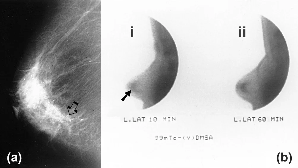 A mammogram in the medio-lateral projection on the left, with an arrow indicating a cluster of fine microcalcifications in the retroareolar region, shown beside corresponding nuclear medicine images of the same breast.