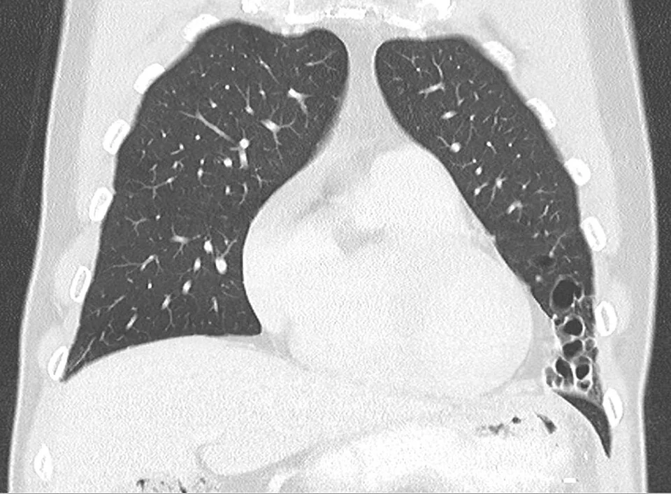 Coronal CT of the chest showing normal lung on the right and, in the left lower zone, a cluster of thin-walled dilated cystic airspaces with visible thickened walls replacing the normal lung architecture.