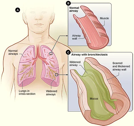 Medical illustration showing lungs in cross-section with normal and widened airways, a close-up of a normal airway wall, and a close-up of an airway with bronchiectasis showing a widened lumen, a scarred and thickened wall, and green mucus filling the lumen.