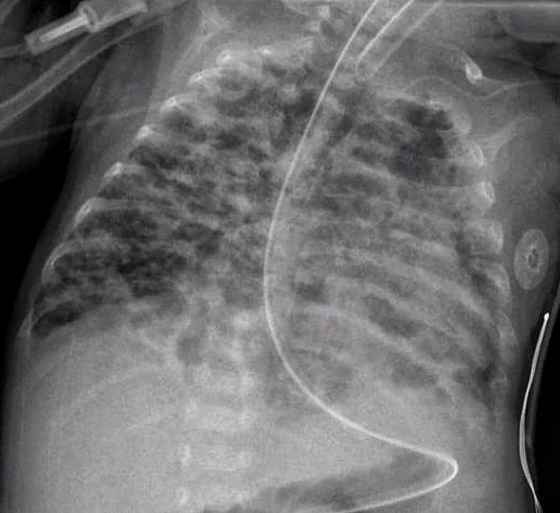 Chest radiograph of an infant showing hyperinflated lungs with a coarse, irregular reticular and cystic pattern throughout both lung fields.