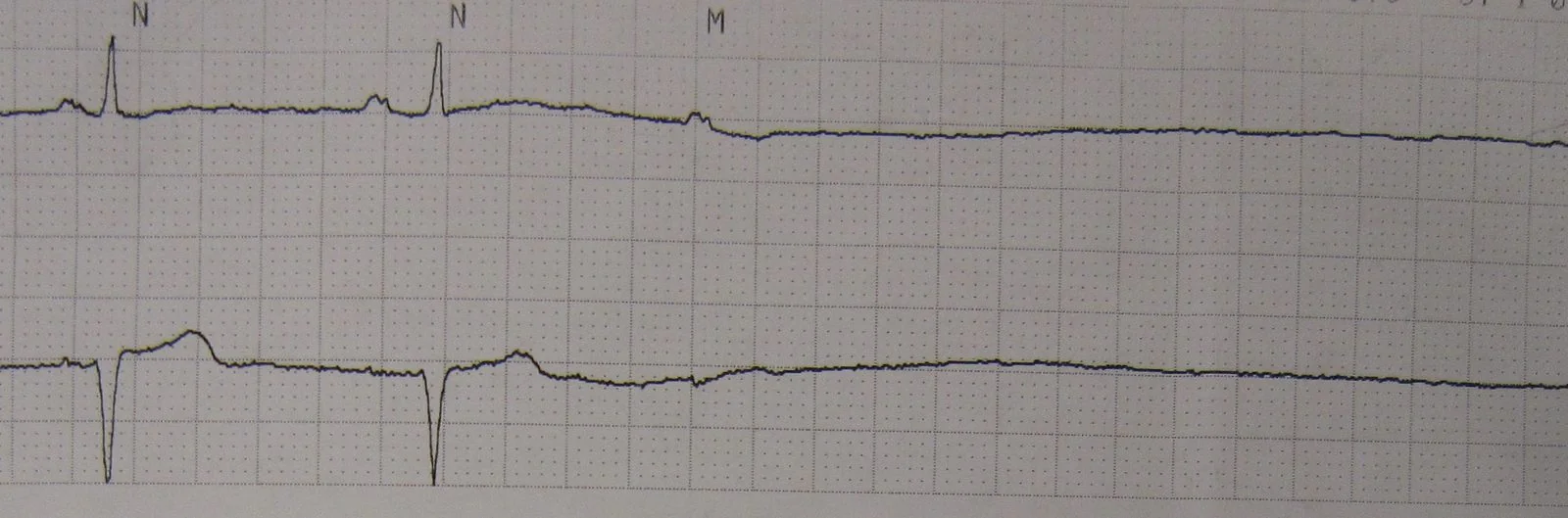 A two-lead ECG rhythm strip showing two normal sinus beats followed by a flat line with no further QRS complexes or organised electrical activity.