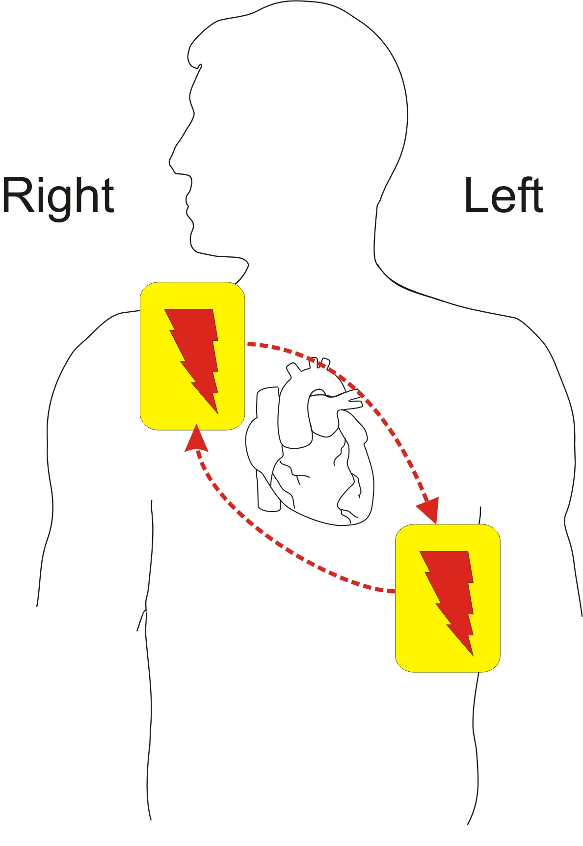 Diagram of a patient's torso showing one defibrillator pad below the right clavicle beside the sternum and the other on the left lower chest in the mid-axillary line, with dashed arrows indicating current passing through the heart between them.
