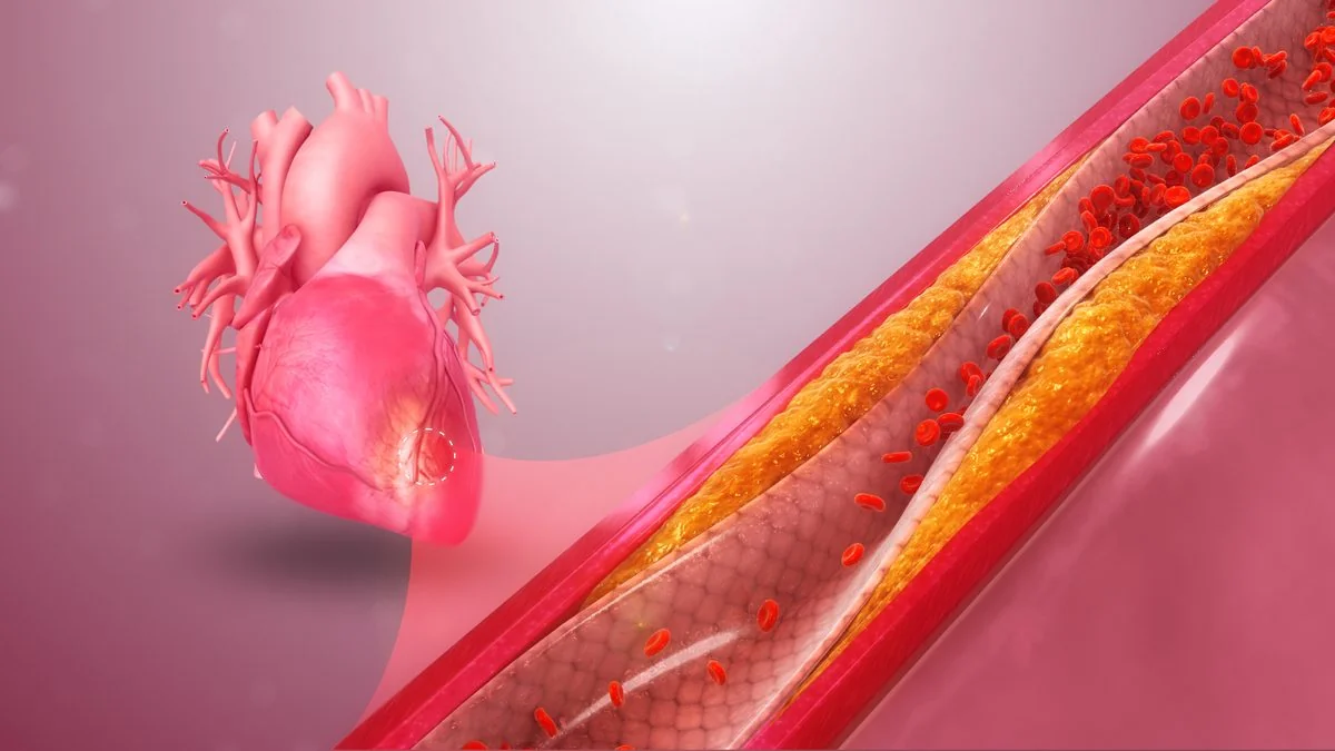 Three-dimensional rendering of the heart with a cutaway of a coronary artery, showing plaque narrowing the vessel and the resulting reduction in blood flow to the myocardium downstream.