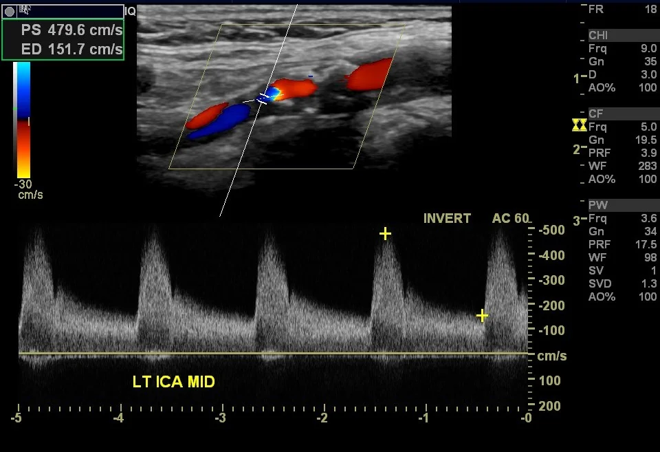 Duplex ultrasound of the neck showing the internal carotid artery with a large echogenic plaque narrowing the lumen to a thin residual channel of colour flow, consistent with near-occlusion.