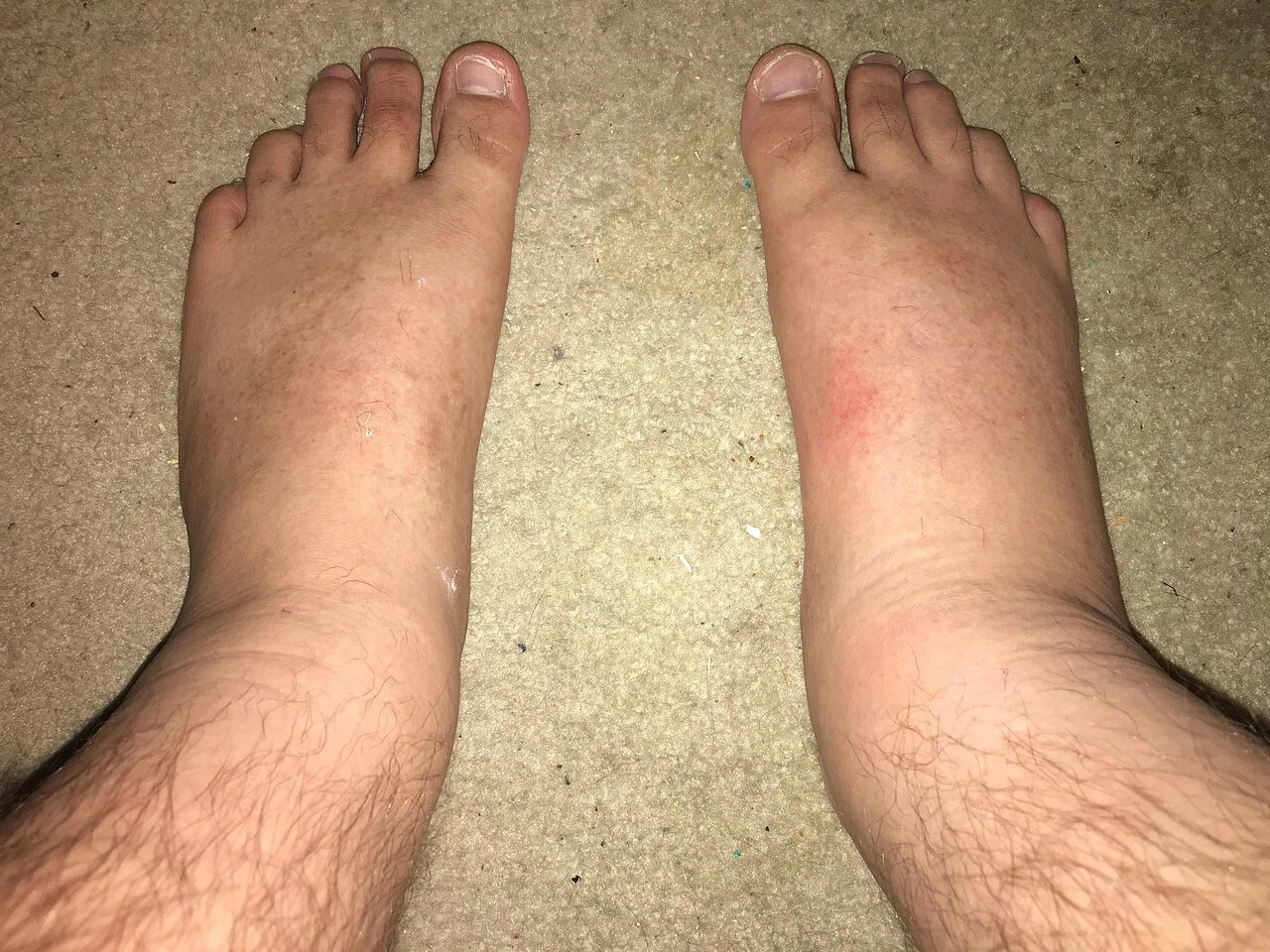 Photograph of the lower leg and foot showing diffuse, poorly demarcated erythema and swelling typical of cellulitis.