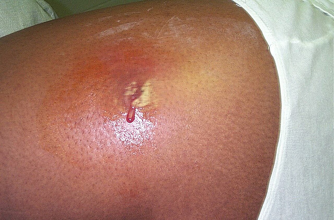 Close-up clinical photograph of a fluctuant, erythematous cutaneous abscess caused by MRSA.