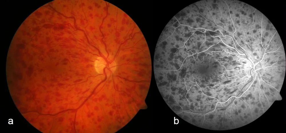 Paired retinal images of central retinal vein occlusion: on the left a colour fundus photograph showing extensive intraretinal haemorrhages across the posterior pole, and on the right the corresponding fluorescein angiogram in which the haemorrhages block the underlying choroidal fluorescence.