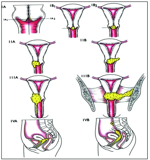 Anatomical diagrams illustrating each FIGO stage of cervical cancer, from IA (microscopic invasion confined to the cervix) through to IVB (distant metastasis).