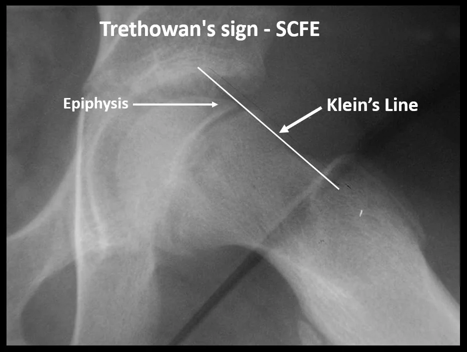 Anteroposterior pelvic radiograph of an adolescent with a line drawn along the superior border of each femoral neck; on the normal side the line clips the femoral head epiphysis, while on the affected side it passes entirely above the epiphysis, which sits lower and medially.