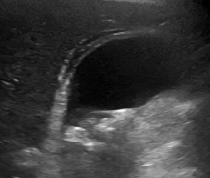 Abdominal ultrasound of the gallbladder showing echogenic gallstones with posterior acoustic shadowing, a markedly thickened gallbladder wall, and a dark rim of pericholecystic fluid between the gallbladder and the adjacent liver.