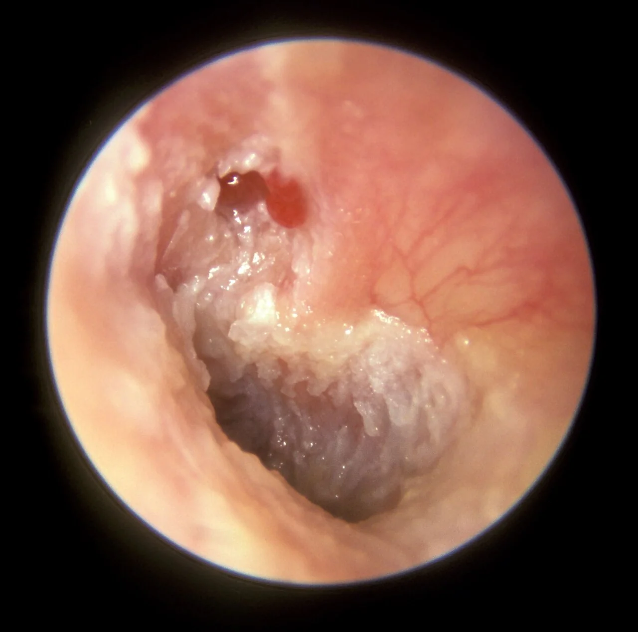 Otoscopic view of an attic cholesteatoma showing a small mass of cherry-red granulation tissue arising from the pars flaccida of the tympanic membrane, with an underlying perforation.