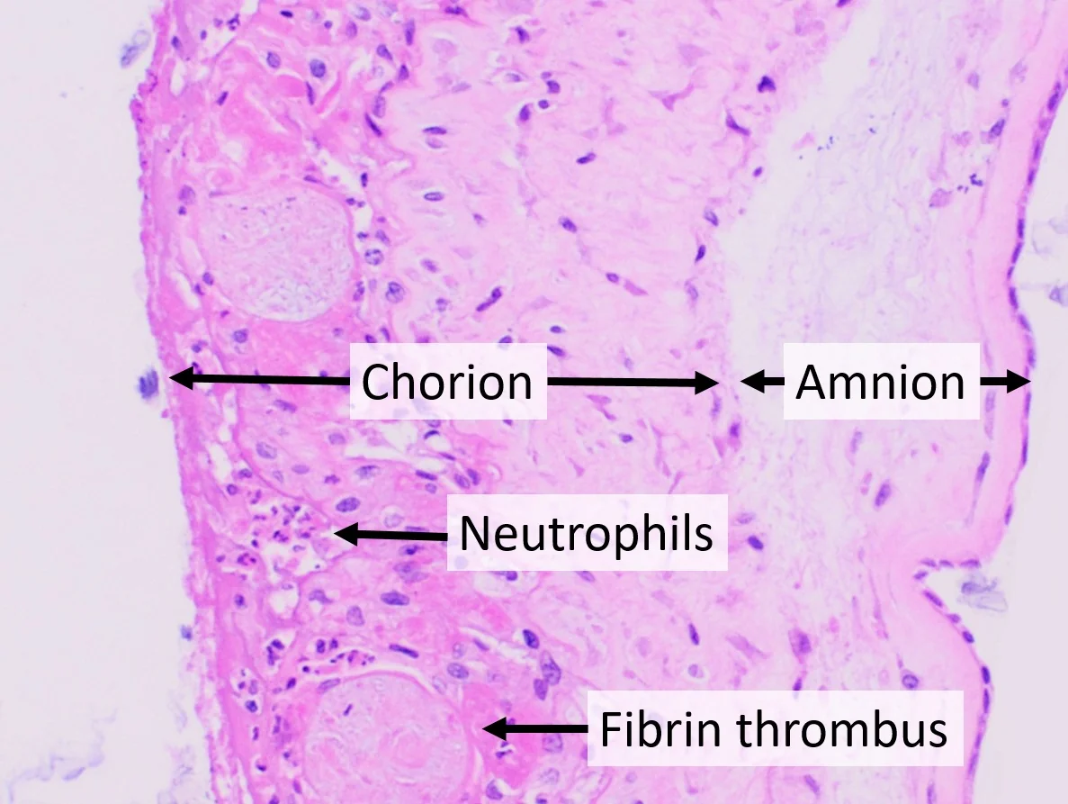 Histological section of fetal membranes showing dense neutrophil infiltration of the chorion.