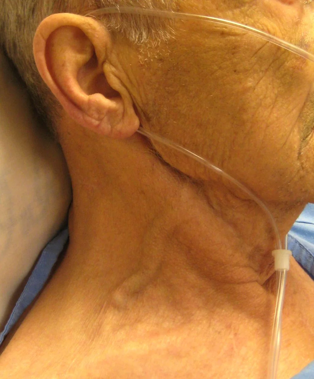 Photograph of the side of a patient's neck showing a markedly distended internal jugular vein, visible as a raised column above the clavicle, in congestive cardiac failure.