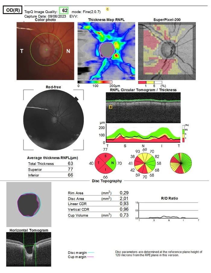 Fundus photograph and topographic image of a glaucomatous right optic disc showing a markedly enlarged central cup occupying most of the disc, with a thinned neuroretinal rim.