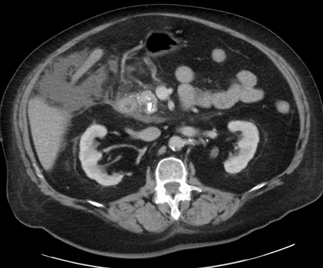 Axial CT of the abdomen showing a calcified stone within a dilated pancreatic duct with surrounding fluid, in chronic pancreatitis.