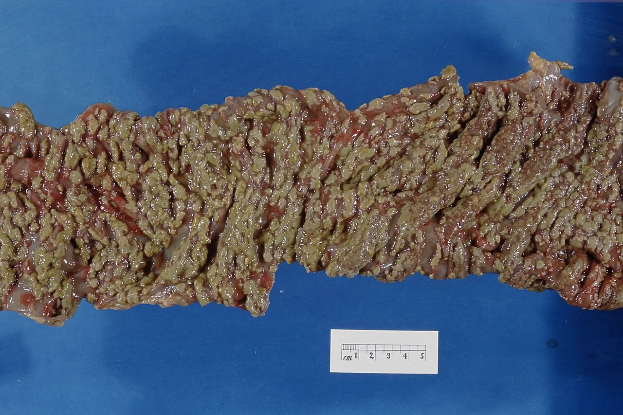 Endoscopic view of the colon showing raised yellow-white pseudomembranous plaques adherent to inflamed mucosa.