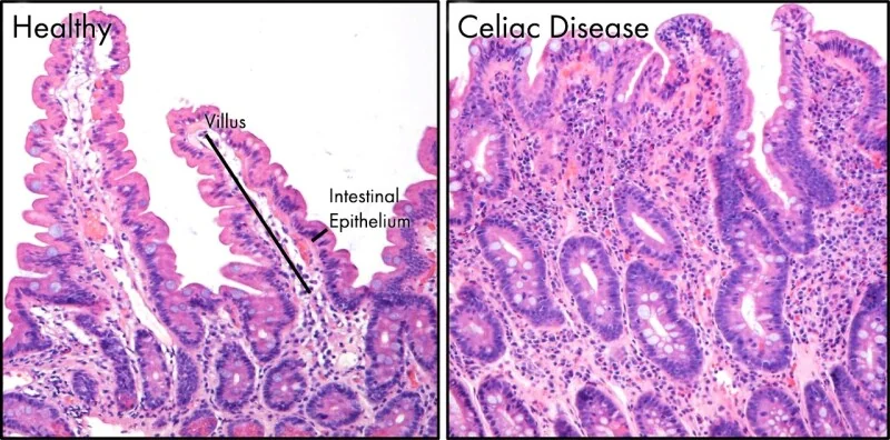 Histology of a duodenal biopsy in coeliac disease showing flattened, atrophic villi with elongated crypts and increased intraepithelial lymphocytes.