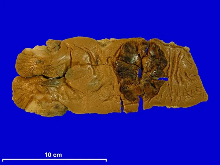 Resected bowel specimen showing an ulcerated colorectal adenocarcinoma with raised, rolled edges narrowing the lumen.