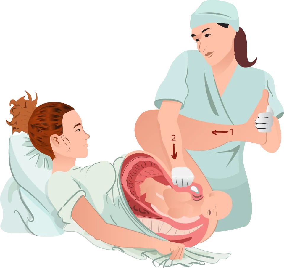 Illustration of the McRoberts manoeuvre with the mother's hips hyperflexed and an assistant applying suprapubic pressure.