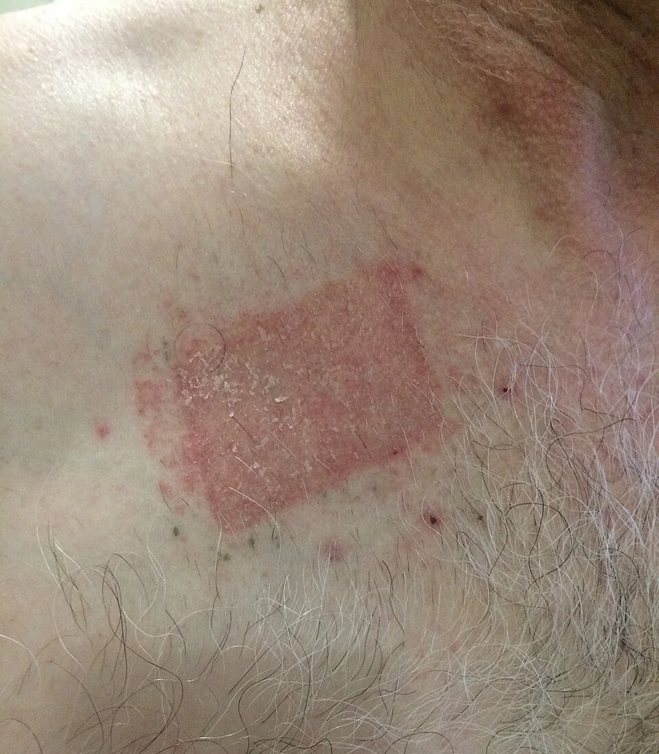 Photograph of an acute allergic contact dermatitis reaction on the skin beneath a transdermal patch, showing sharply demarcated erythema and vesiculation confined to the area of adhesive contact.