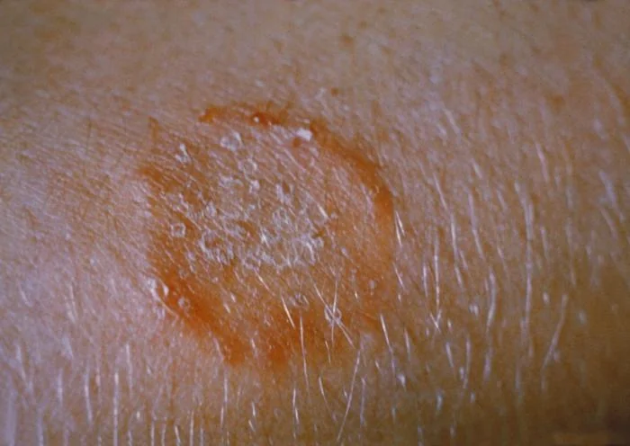 Photograph of ringworm (tinea corporis) on the arm, showing an annular, erythematous, scaly plaque with a raised active edge and central clearing.