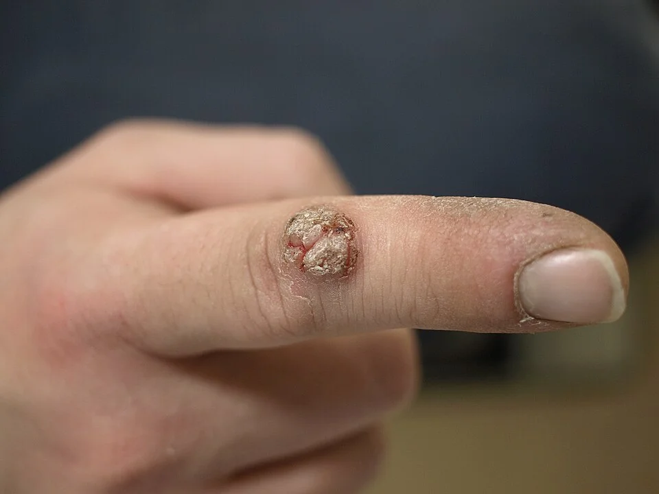 Photograph of a common wart (verruca vulgaris) on a finger, showing a firm, rough, papillomatous, hyperkeratotic papule with a roughened surface.