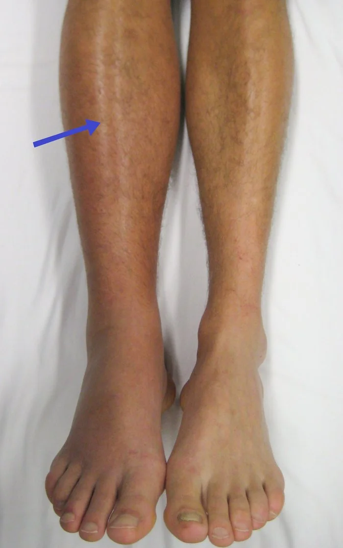 Photograph of a patient's legs showing marked swelling and redness of the right leg compared with the left, due to deep vein thrombosis.