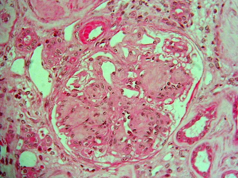 Light micrograph of a renal biopsy showing a glomerulus with expanded mesangium and rounded acellular nodules of hyaline material within the glomerular tuft, characteristic of nodular diabetic glomerulosclerosis.